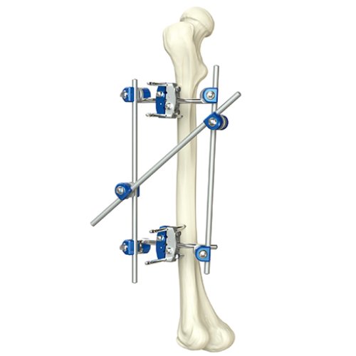 Tibia & Percone External Fixator