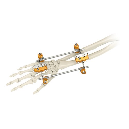 Ulna & Radius External Fixator