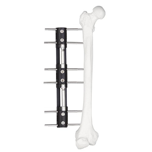 Bone Lengthening External Fixator - Type A